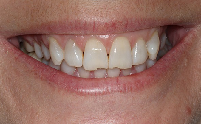 Before - Westcountry Dental and Implant Centre