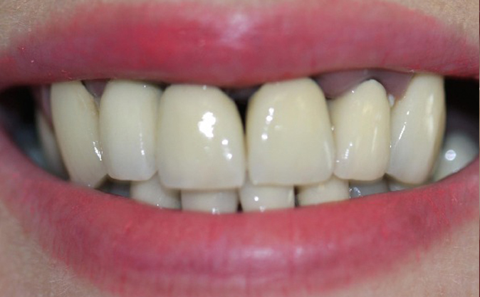 Before - Westcountry Dental and Implant Centre