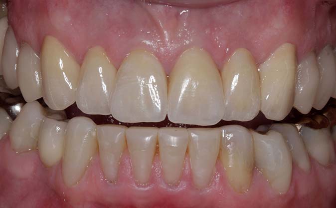After - Westcountry Dental and Implant Centre
