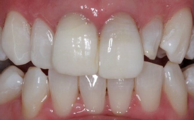 After - Westcountry Dental and Implant Centre